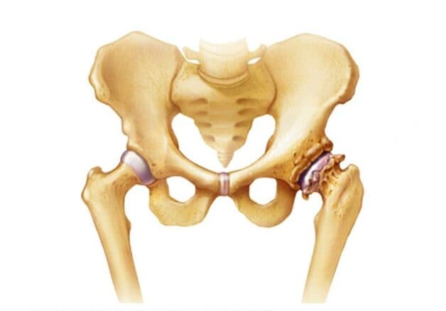 Khớp háng thoái hóa có thể gây ra các cơn đau, nhức, gây ảnh hưởng trực tiếp đến cuộc sống thường ngày của bệnh nhân