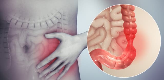 Bệnh viêm đại tràng ruột già có nguy hiểm không?