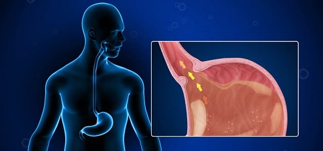 Bệnh trào ngược dạ dày và cách chữa