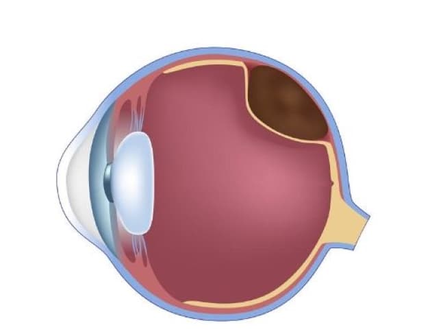 Võng mạc là một bộ phận quan trọng của mắt, cấu tạo là màng thần kinh dạng mỏng