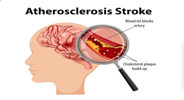 Triệu chứng tai biến mạch máu não ai cũng cần biết
