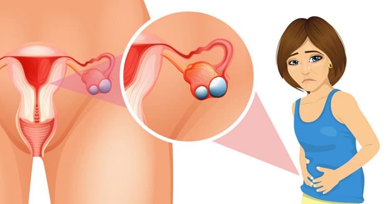 U nang buồng trứng là những túi nang phát triển bất thường ở khu vực buồng trứng