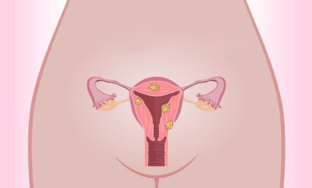 Phân loại u nang buồng trứng – u nang thực thể