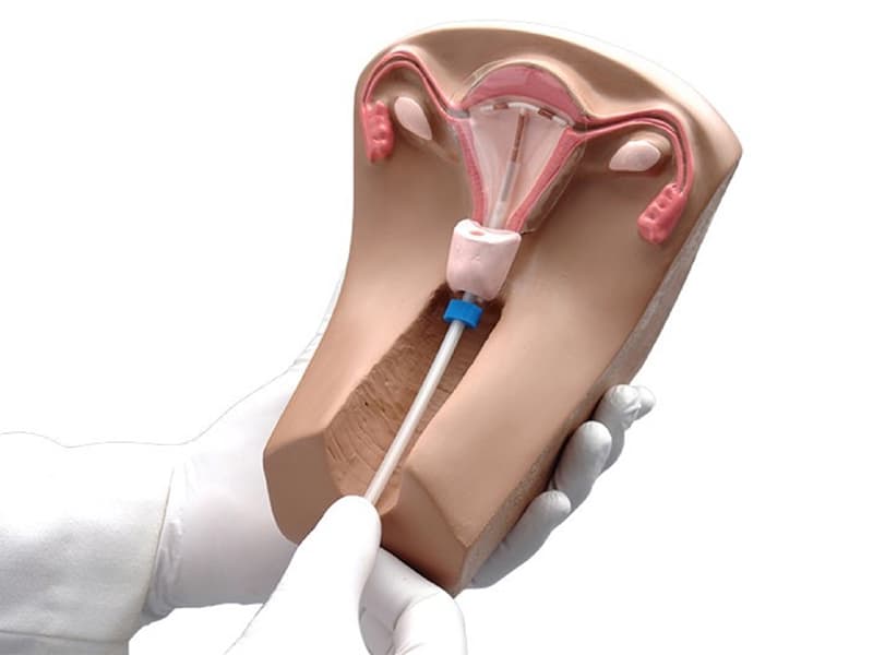 Đặt vòng tránh thai là thủ thuật đặt một dụng cụ nhỏ có tác dụng ngừa thai vào lòng tử cung để tạo ra hiệu quả ngừa thai