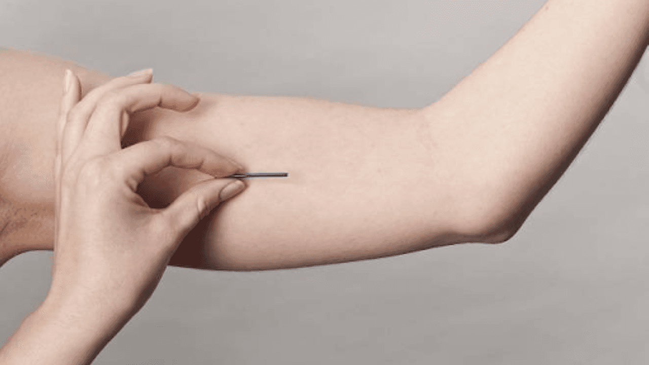 Sử dụng que tránh thai là biện pháp ngừa thai phù hợp khi mắc u xơ tử cung