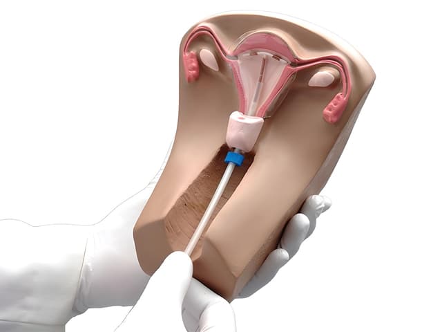 U xơ tử cung đặt vòng có sao không? Biện pháp ngừa thai phù hợp!