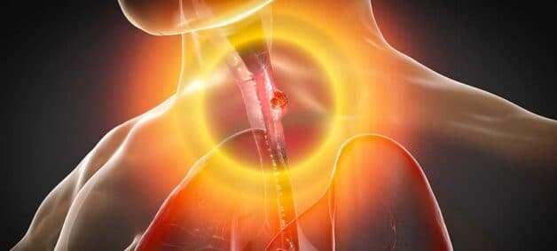 Thông tin về chi phí thực hiện điều trị ung thư thực quản