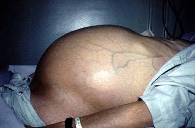 Ung thư gan giai đoạn đầu chưa xuất hiện cổ trướng, nếu xuất hiện là ở giai đoạn nặng rồi 