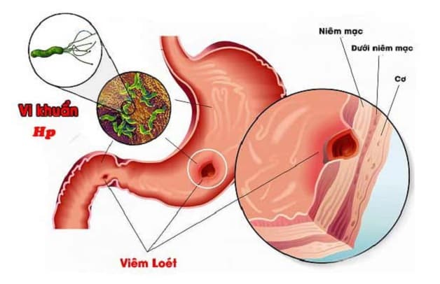 cách phòng ngừa vi khuẩn hp là gì