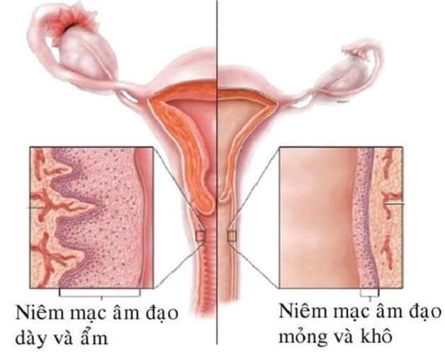Viêm âm đạo teo thường gặp ở phụ nữ tiền mãn kinh và mãn kinh