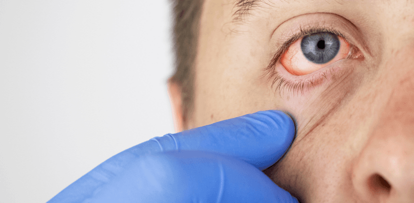 Chẩn đoán viêm kết mạc cấp tính bằng cách nào?