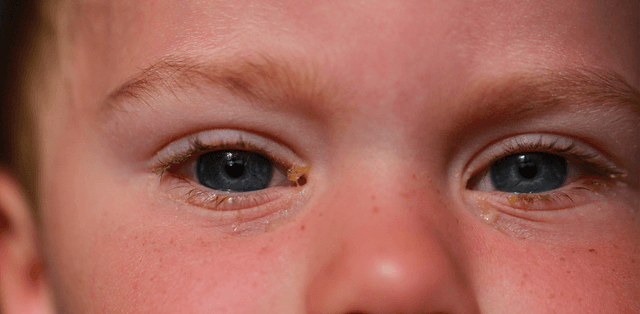 Viêm kết mạc ở trẻ em và hướng điều trị đúng