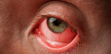 Hiểu đúng về viêm kết mạc và cách điều trị hiệu quả