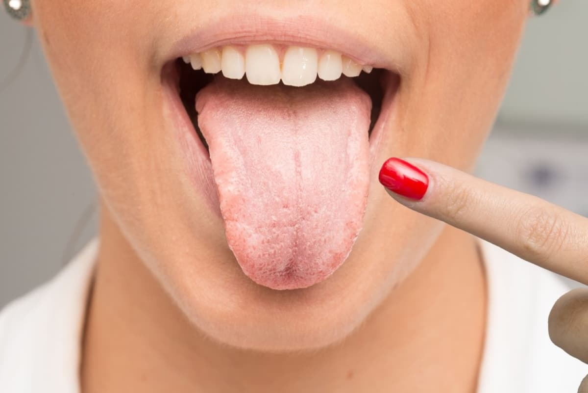 Bệnh viêm lưỡi và những triệu chứng