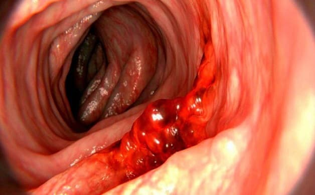 Xuất huyết đại tràng là biến chứng khá phổ biến ở hệ tiêu hóa