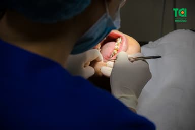 Niềng răng thưa hết bao nhiêu lâu?