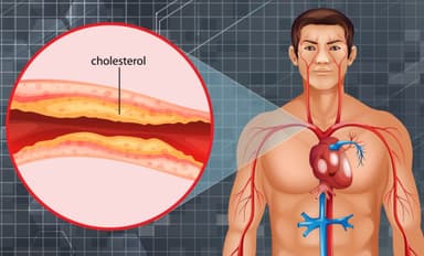 Bệnh xơ vữa động mạch vành biến chứng nguy hiểm không?
