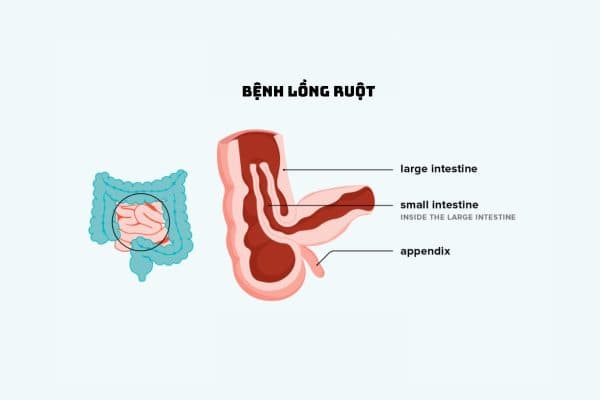 Lồng ruột là tình trạng về sức khỏe nguy hiểm ở trẻ nhỏ