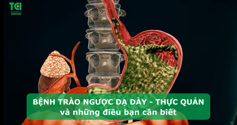 Bệnh trào ngược dạ dày thực quản và những điều bạn cần biết