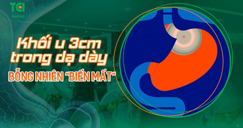 Siêu âm nội soi vạch trần u gan đội lốt u dạ dày