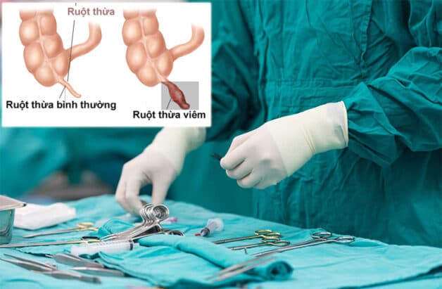 Phẫu thuật là phương pháp tối ưu đối với trường hợp bệnh đau ruột thừa.