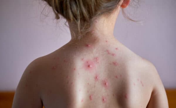 bệnh thủy đậu có được tắm không