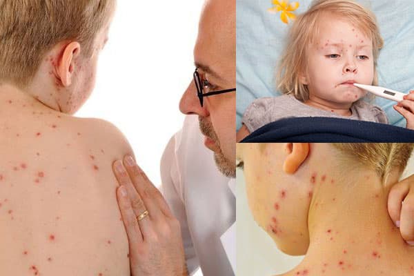 Bệnh thủy đậu ở trẻ nhỏ là gì? Những điều cần biết.