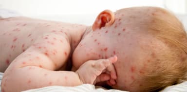 Bệnh thủy đậu ở trẻ nhỏ &#8211; cẩm nang siêu hữu ích