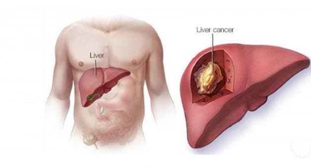 Ung thư gan là biến chứng nguy hiểm của bệnh xơ gan