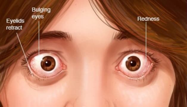 bị lồi mắt điều trị