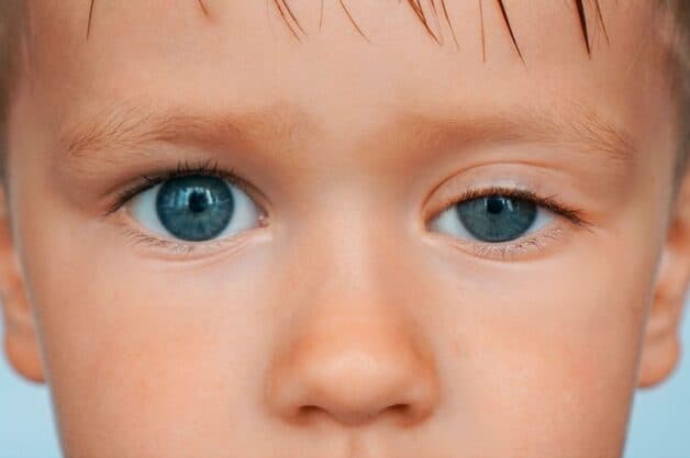 Khi một người nhìn thẳng mà mí trên sa xuống thấp hơn vị trí bình thường ta nói người đó bị sụp mí.