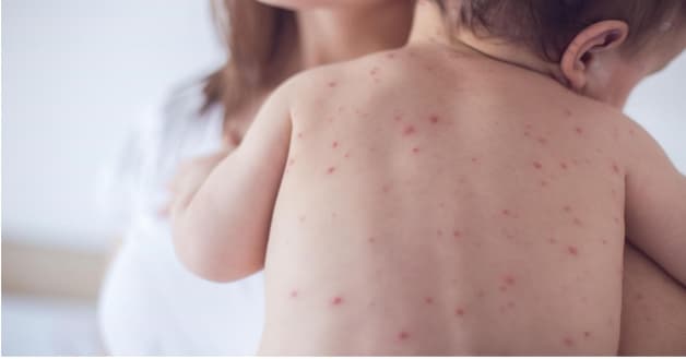 cách chữa bệnh thủy đậu