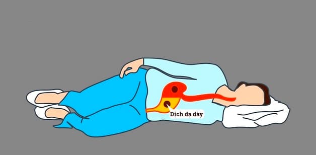cách nằm giảm đau bao tử