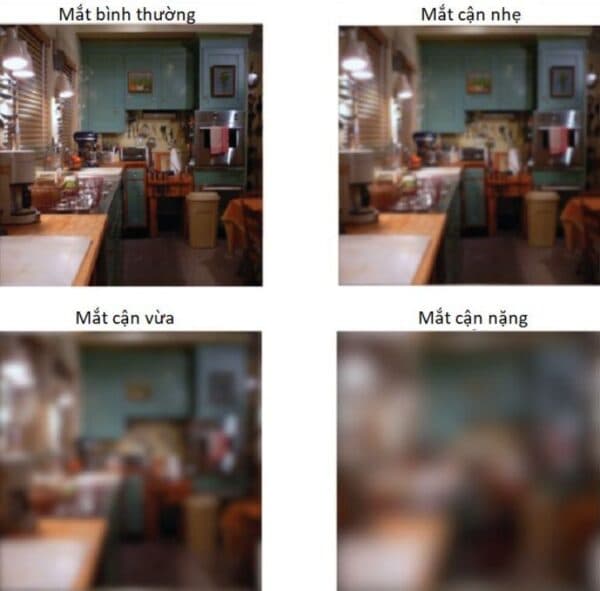 Cận thị là gì?