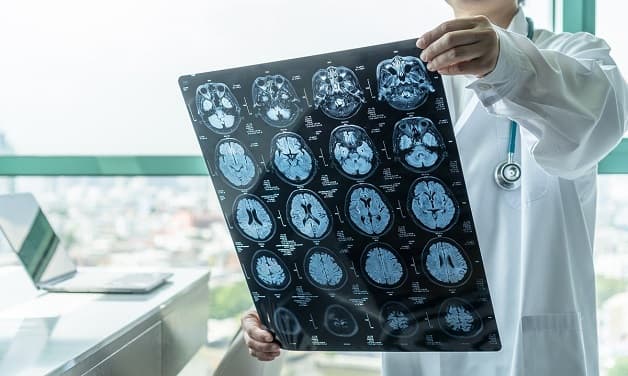 chẩn đoán đột quỵ nhồi máu não bằng cách nào?