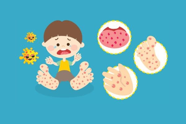 Bệnh chân tay miệng ở trẻ em thường do virus gây ra