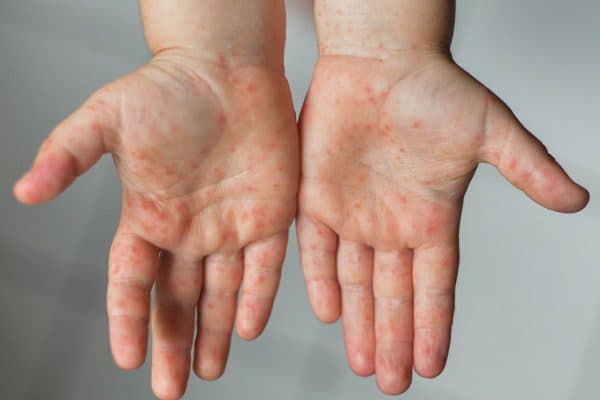 Trẻ mắc tay chân miệng thường có biểu hiện sốt cao, xuất hiện ban đỏ ở tay, chân, miệng...