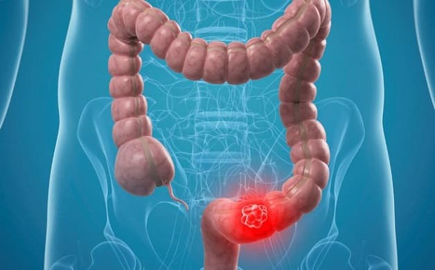 Viêm ruột có thể gây ra dấu hiệu của đau ruột thừa