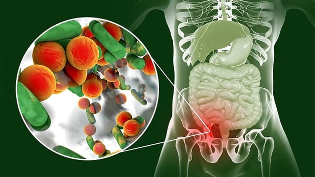 Dấu hiệu của viêm ruột thừa là gì?