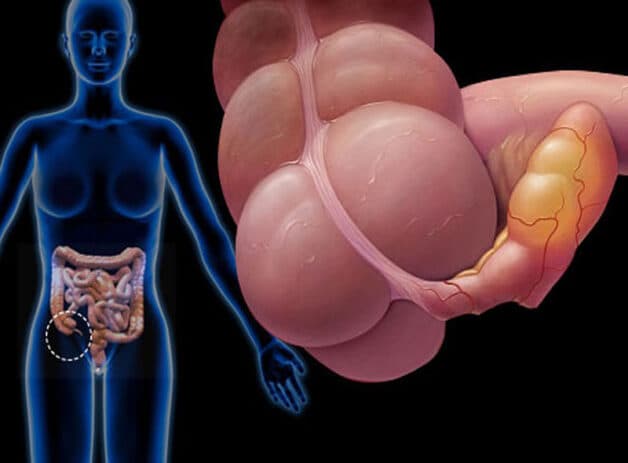 Vị trí ruột thừa trong cấu trúc ống tiêu hóa.