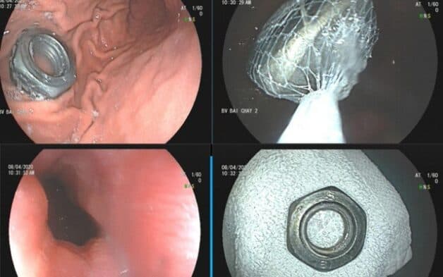 đau họng nuốt dị vật