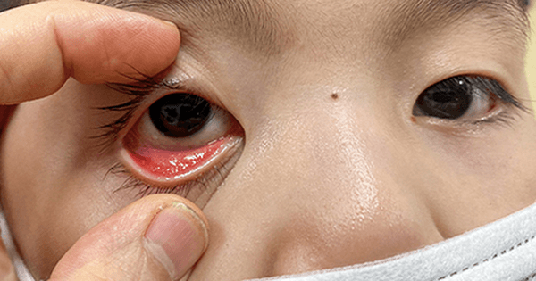 Đau mắt đỏ ở trẻ em là gì?