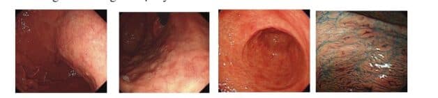Dị sản ruột ở dạ dày là tình trạng tiếp theo của viêm teo dạ dày.