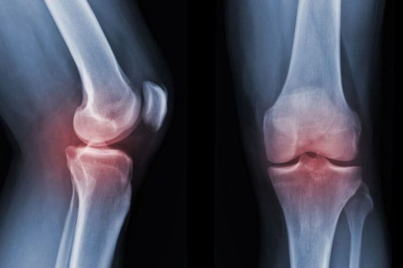 gai thoái hóa khớp gối