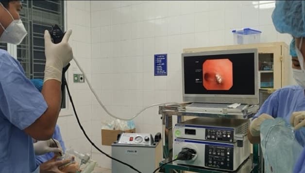 gắp dị vật trong họng