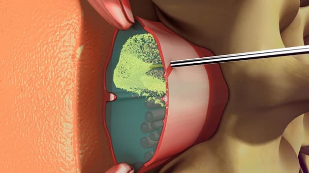 Gây tê ngoài màng cứng là một kỹ thuật được sử dụng phổ biến trong sản khoa