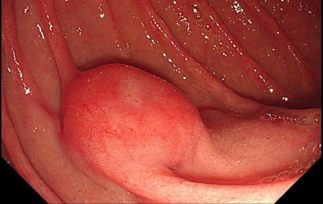 Hình ảnh u GIST đại tràng qua nội soi