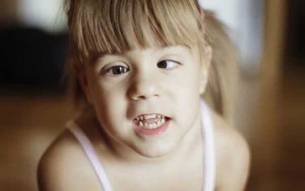 Tại sao bé bị bệnh lác mắt?