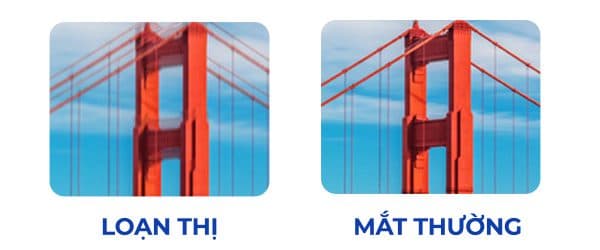 loạn thị có chưa khỏi được không?