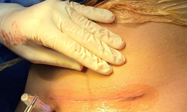 Keo sinh học là một loại keo đặc biệt, an toàn, lành tính, được sử dụng trực tiếp trên vết thương